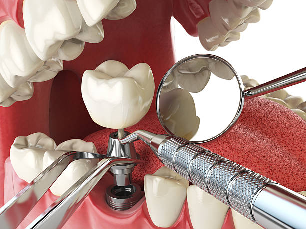 Best Emergency Denture Repair in Pelican Marsh, FL
