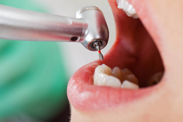 Best Dental Abscess Treatment in Pelican Marsh, FL